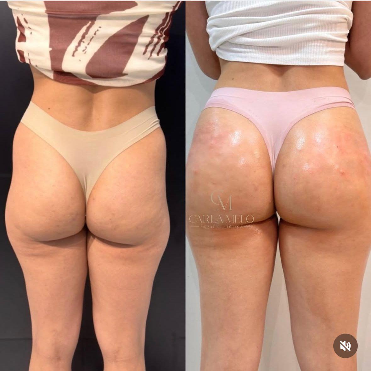 Resultado antes e depois 4